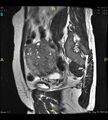 Adenomyosis (Radiopaedia 43504-46889 Sagittal T2 8).jpg