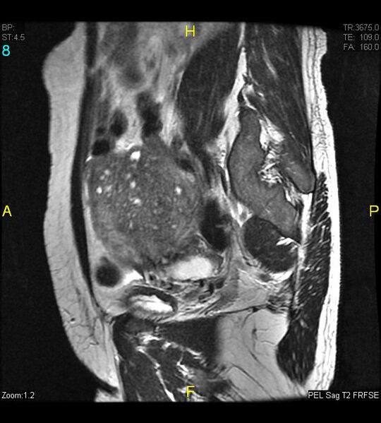 File:Adenomyosis (Radiopaedia 43504-46889 Sagittal T2 8).jpg