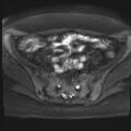 Adenomyosis and endometriotic cysts (Radiopaedia 82300-96367 Axial DWI 18).jpg