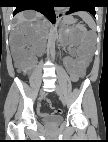 File:Adult polycystic kidney disease (Radiopaedia 47866-52626 Coronal non-contrast 28).png