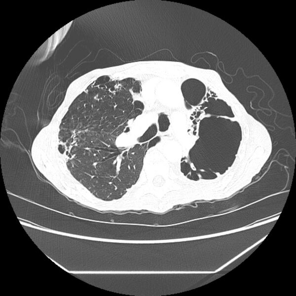 File:Advanced pulmonary tuberculosis (Radiopaedia 8599-9431 Axial lung window 19).jpg