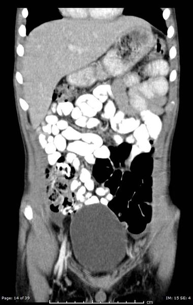 File:Agenesis of the gallbladder (Radiopaedia 55454-61905 A 14).jpg