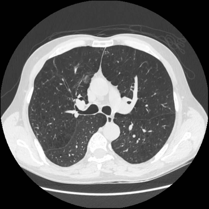 Alpha-1-antitrypsin deficiency (Radiopaedia 40993-43722 Axial lung window 95).jpg