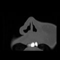 Ameloblastic fibro-odontoma (Radiopaedia 18843-18780 B 2).jpg