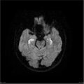 Amnestic syndrome secondary to hypoxic brain injury (Radiopaedia 24743-25004 DWI 12).jpg