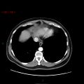 Ampullary carcinoma (Radiopaedia 56396-63056 B 11).jpg