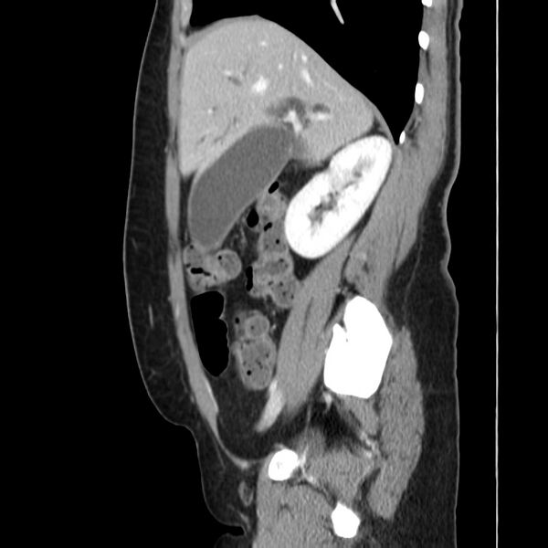 File:Ampullary tumor (Radiopaedia 22787-22816 D 19).jpg
