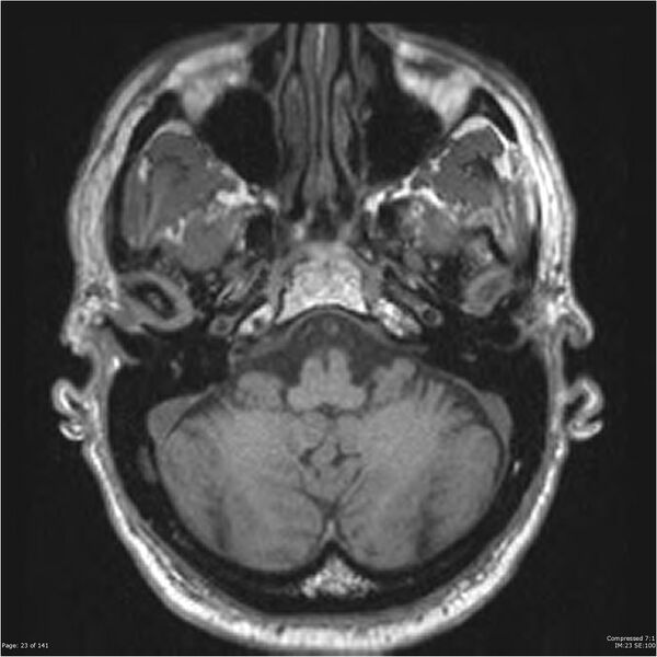 File:Anaplastic meningioma with recurrence (Radiopaedia 34452-35788 Axial T1 21).jpg