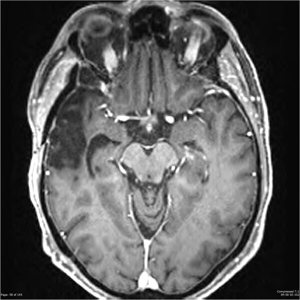 File:Anaplastic meningioma with recurrence (Radiopaedia 34452-35788 Axial T1 C+ 58).jpg