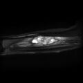 Aneurysmal bone cyst - radius (Radiopaedia 5866-7442 Coronal PD fat sat 1).jpg