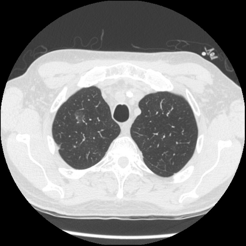 Angioinvasive aspergillosis (Radiopaedia 43957-47466 Axial lung window 15).jpg