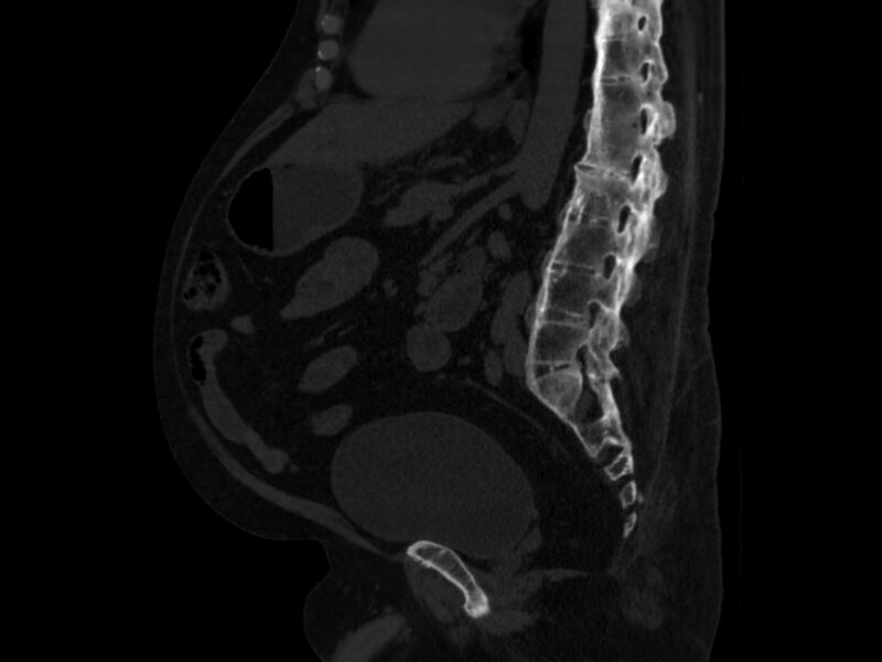File:Ankylosing spondylitis (Radiopaedia 44609-48357 Sagittal bone window 60).jpg