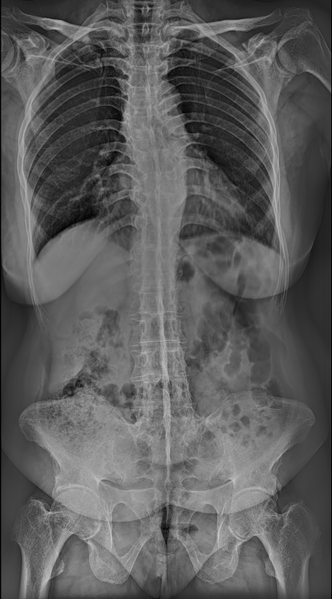 File:Ankylosing spondylitis with dagger sign (Radiopaedia 61271-69171 E 1).PNG