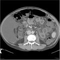 Annular pancreas and cirrhosis (Radiopaedia 24561-24843 A 18).jpg