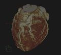Anomalous left coronary artery from the pulmonary artery (ALCAPA) (Radiopaedia 40884-43586 3D reconstruction 2).jpg