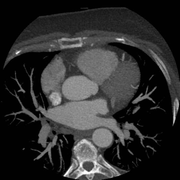 File:Anomalous origin of left circumflex artery from right coronary sinus (Radiopaedia 72563-83117 A 41).jpg