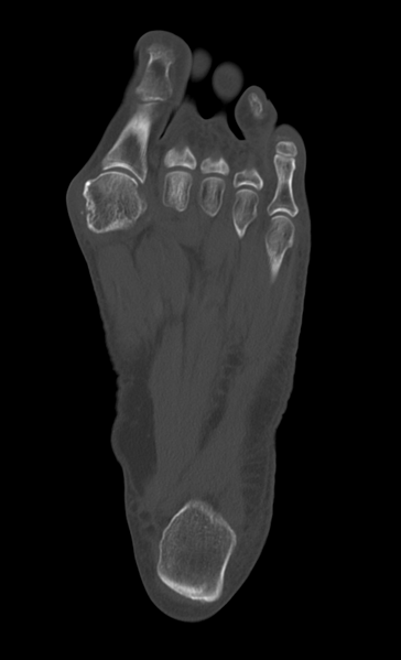 File:Anterior calcaneal process fracture (Radiopaedia 47384-51989 Axial bone window 27).png