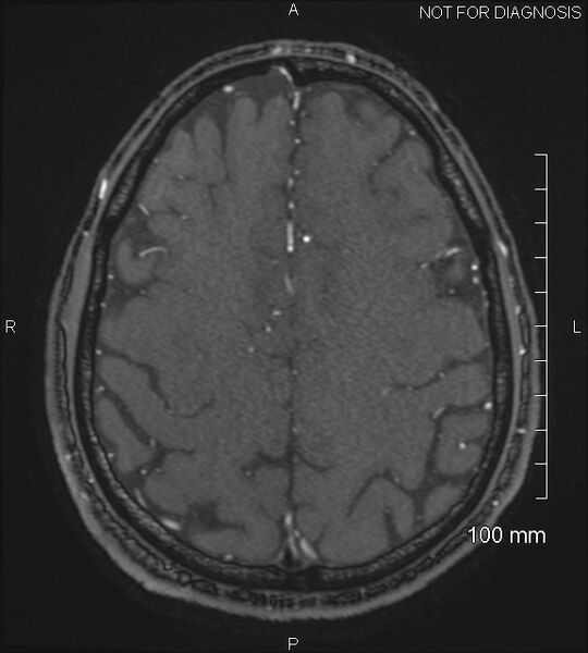 File:Anterior cerebral artery aneurysm (Radiopaedia 80683-94127 Axial MRA 195).jpg