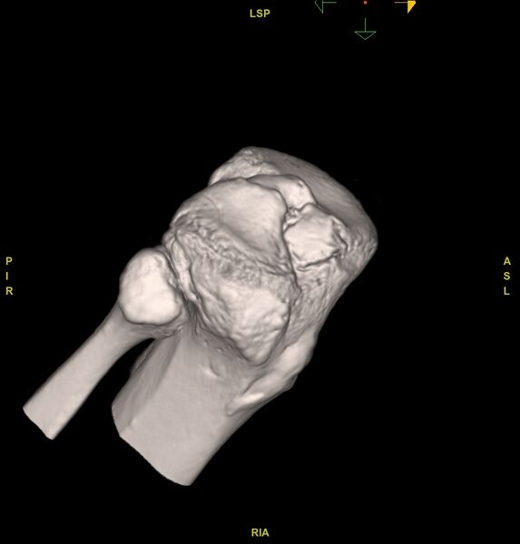 File:Anterior cruciate ligament avulsion fracture (Radiopaedia 58939-66194 VRT 1).jpg