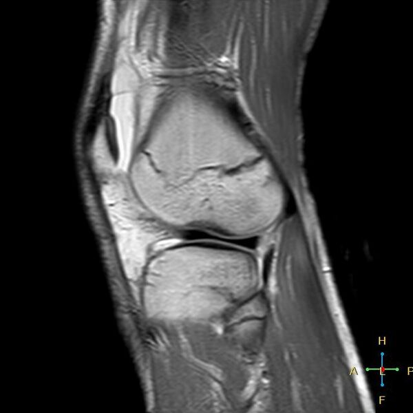 File:Anterior cruciate ligament tear - complete (Radiopaedia 24907-25170 Sagittal PD 3).jpg