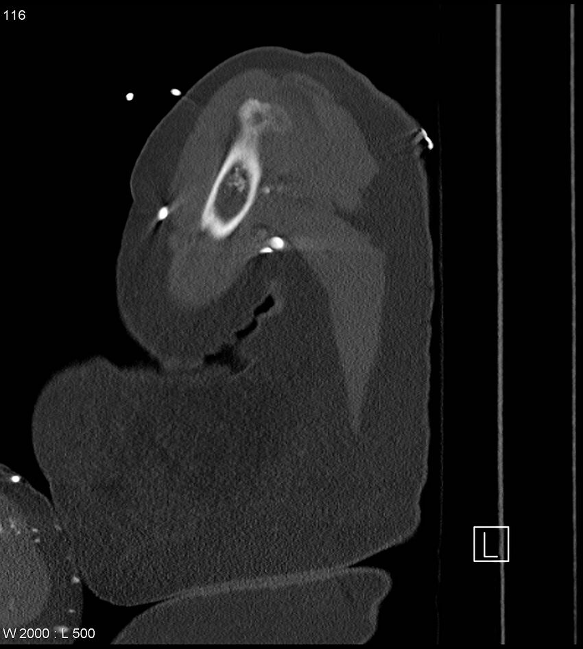 Anterior shoulder dislocation (CT) (Radiopaedia 59032-66309 Sagittal bone window 58).jpg