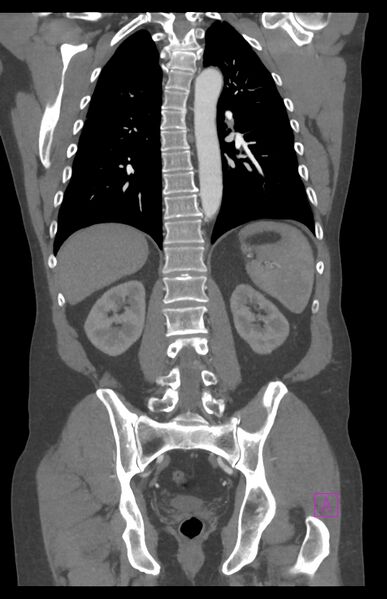 File:Aortectomy and axillary-bifemoral bypass (Radiopaedia 28303-28545 C 63).jpg