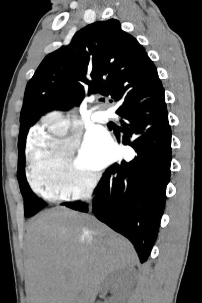 File:Aortic coarctation with aneurysm (Radiopaedia 74818-85828 B 59).jpg