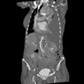 Aortic dissection (Radiopaedia 68763-78691 B 14).jpeg