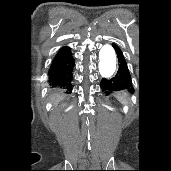 File:Aortic dissection - DeBakey Type I-Stanford A (Radiopaedia 79863-93115 B 34).jpg