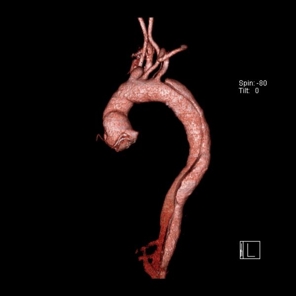 File:Aortic dissection - De Bakey type III - Stanford B (Radiopaedia 21903-21882 3D C+ arterial phase 15).jpg