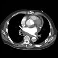 Aortic dissection with rupture into pericardium (Radiopaedia 12384-12647 A 32).jpg