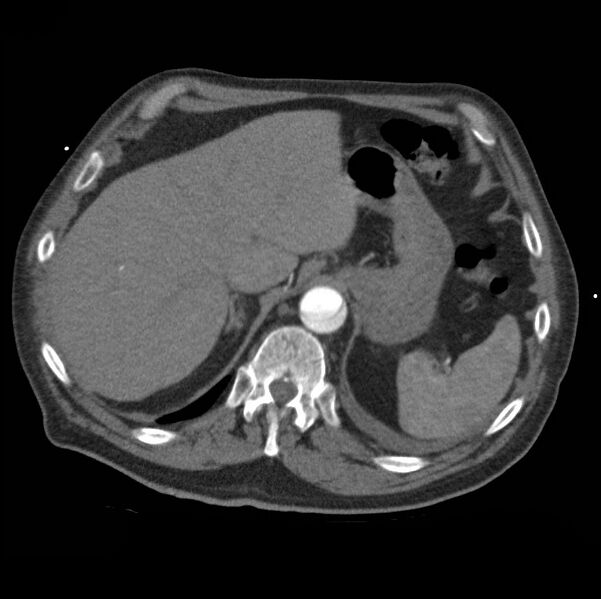 File:Aortic dissection with rupture into pericardium (Radiopaedia 12384-12647 A 50).jpg