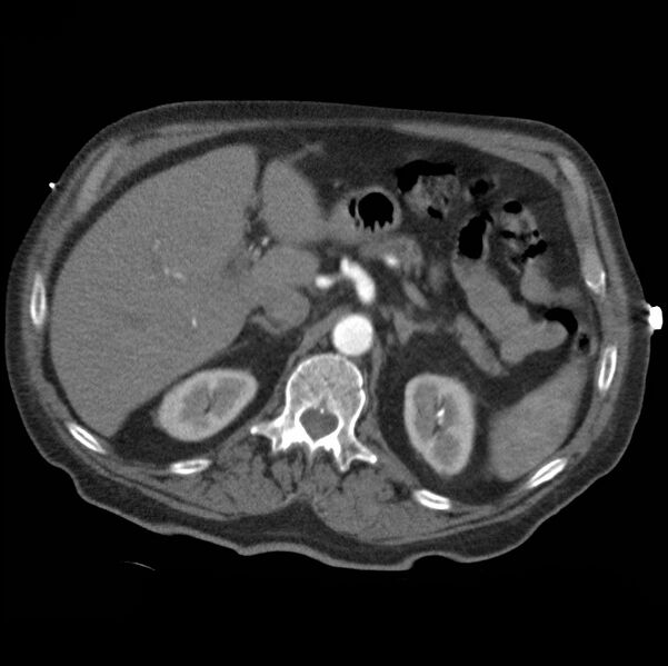 File:Aortic dissection with rupture into pericardium (Radiopaedia 12384-12647 A 56).jpg