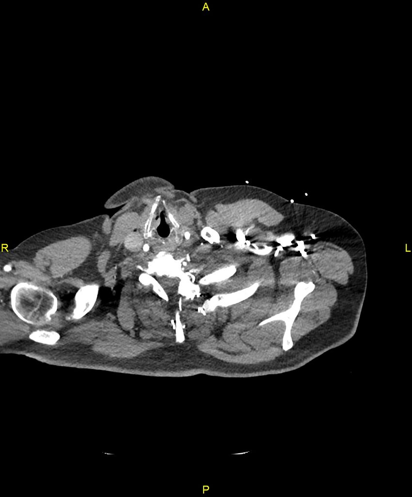 Aortic rupture (Radiopaedia 88822-105594 B 1).jpg