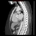 Aortic valve stenosis (Radiopaedia 14480-14423 B 3).jpg
