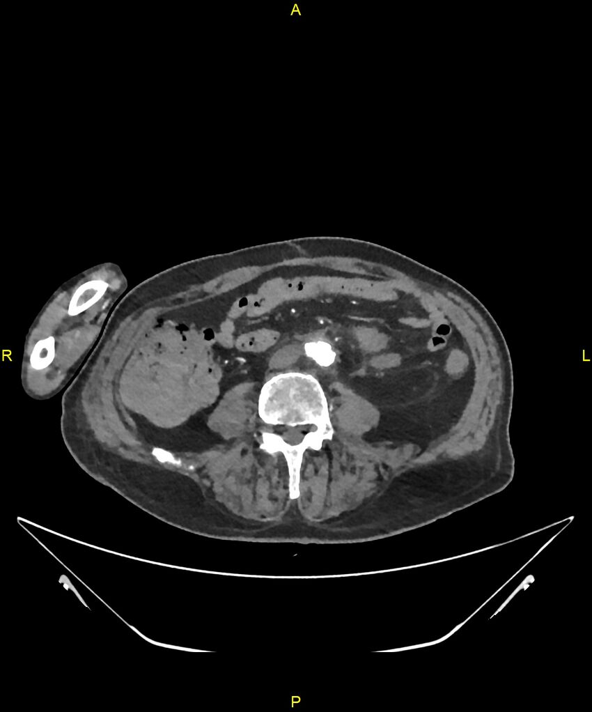 Aortoenteric fistula (Radiopaedia 84308-99603 B 223).jpg