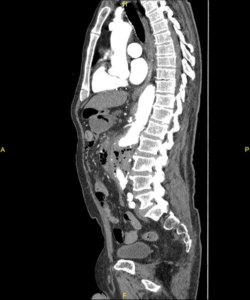 File:Aortoenteric fistula (Radiopaedia 84308-99603 C 187).jpg