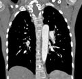 Aortopulmonary window, interrupted aortic arch and large PDA giving the descending aorta (Radiopaedia 35573-37074 D 48).jpg
