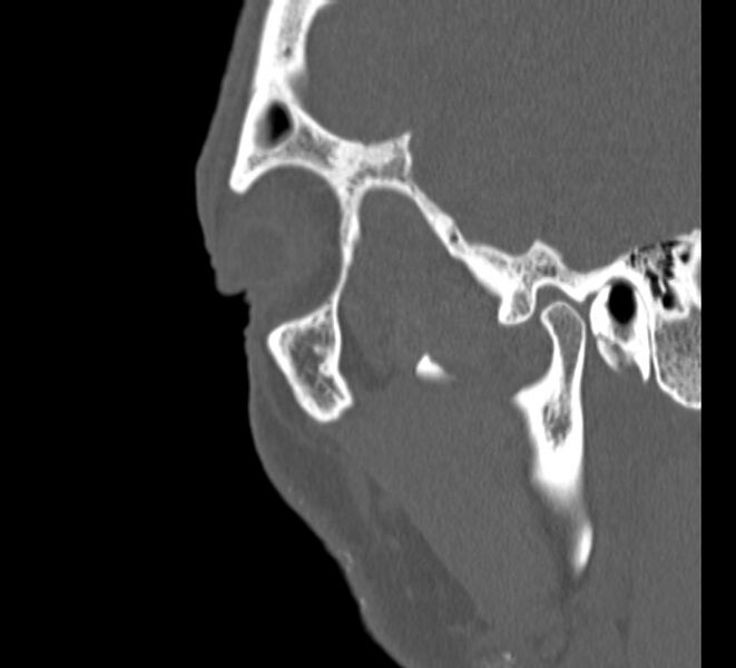 File:Aplastic maxillary sinuses (Radiopaedia 60030-67561 Sagittal bone window 32).jpg