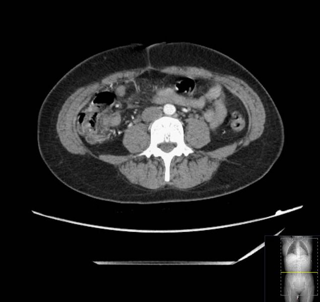 File:Appendicitis (CT angiogram) (Radiopaedia 154713-127660 Axial 57).jpg