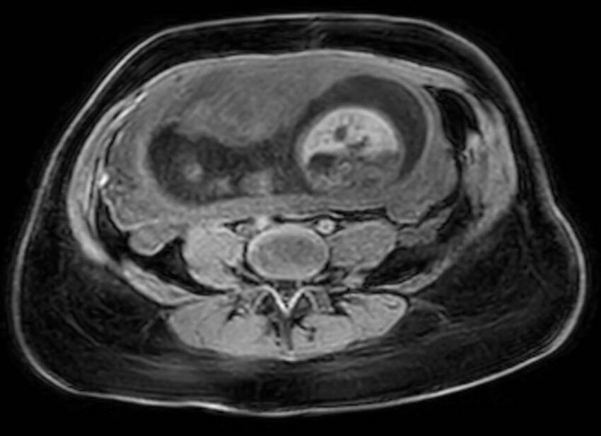 Appendicitis in gravida (MRI) (Radiopaedia 89433-106395 Axial DIXON 91).jpg