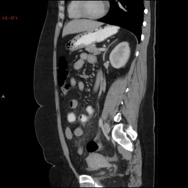 File:Appendicitis with microperforation- promontoric type (Radiopaedia 27268-27442 A 32).jpg