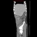 Appendicitis with phlegmon (Radiopaedia 9358-10046 F 5).jpg