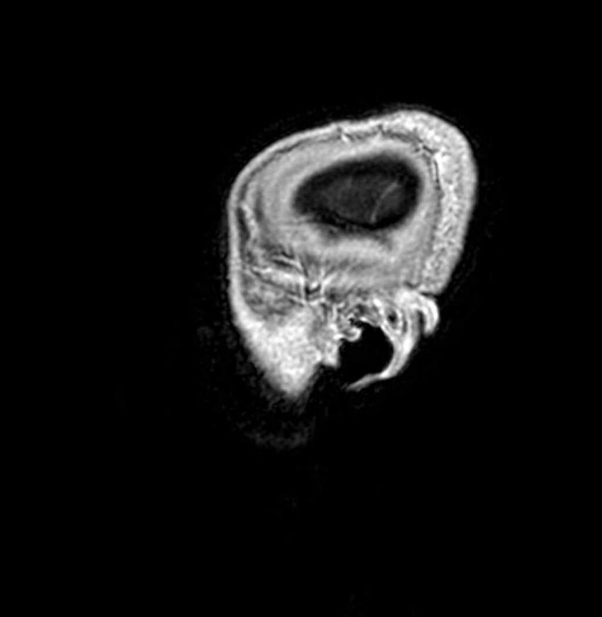 Arachnoid cyst- extremely large (Radiopaedia 68741-78451 Sagittal T1 C+ 72).jpg
