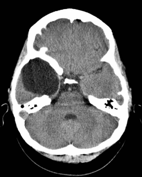 File:Arachnoid cyst - middle cranial fossa (Radiopaedia 2581-6274 Axial non-contrast 1).jpg
