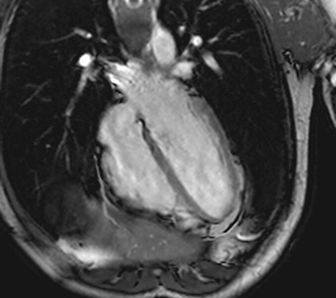 File:Arrhythmogenic right ventricular cardiomyopathy (Radiopaedia 39806-42237 D 100).jpg