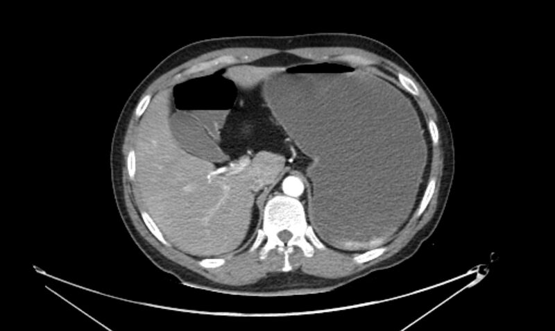 File:Arterial occlusive mesenteric ischemia (Radiopaedia 84641-100060 A 34).jpg