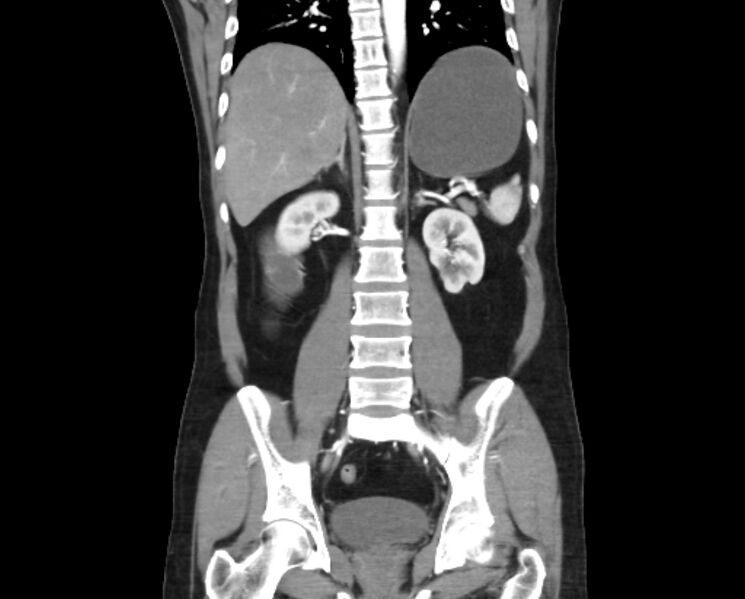 File:Arterial occlusive mesenteric ischemia (Radiopaedia 84641-100060 B 36).jpg