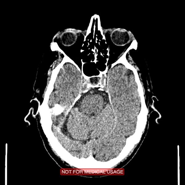 File:Artery of Percheron infarction (Radiopaedia 28679-28967 Axial non-contrast 38).jpg