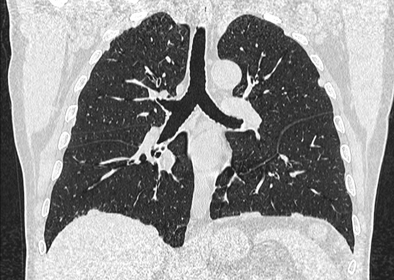 File:Asbestos pleural placques (Radiopaedia 57905-64872 Coronal lung window 160).jpg